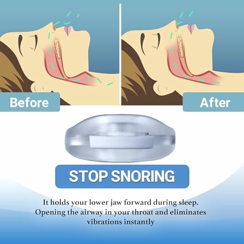 Comparison of snoring before and after using a mouthpiece.